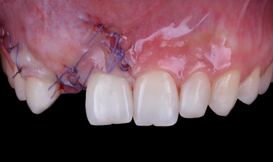 Fig. 9 - Chiusura della ferita per prima intenzione.