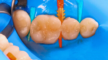 Fig. 2: Immediately after polymerisation, the composite is covered with an oxygen inhibition layer.