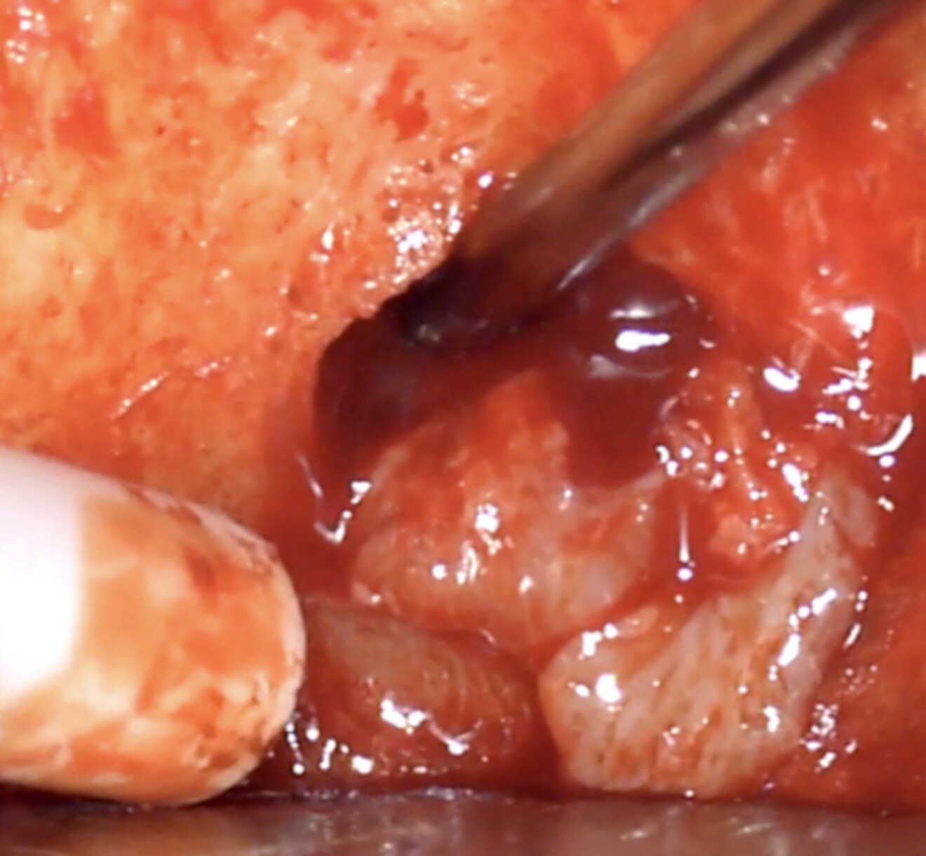 Fig. 4b: Removing the cyst from around the root without damaging the surface, followed by surface treatment of the exposed part of the root.