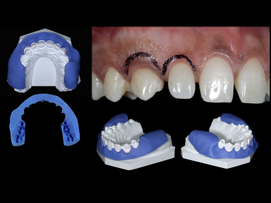 Fig. 51: Silicone index for crown lengthening and the new prosthetic marginal design marked in the cervical area with a black pen.