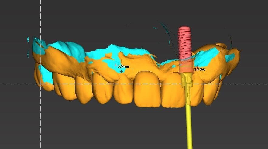 Fig. 13_Visione senza dima con l’inclinazione vestibolo-mediale sul 2.2.