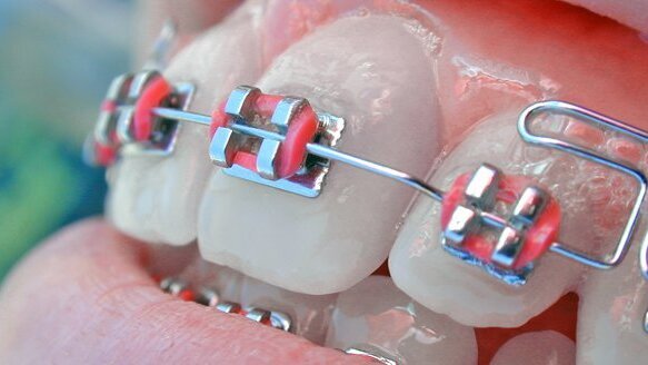 Nieprawidłowy zgryz wpływa na wygląd całej twarzy