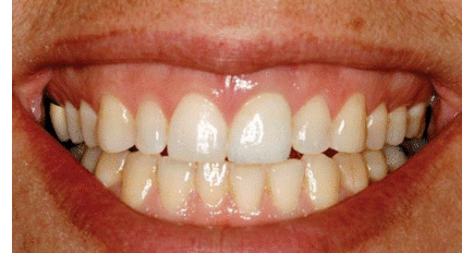 La dentisterie restauratrice basée sur l'implant : le futur, c'est maintenant !