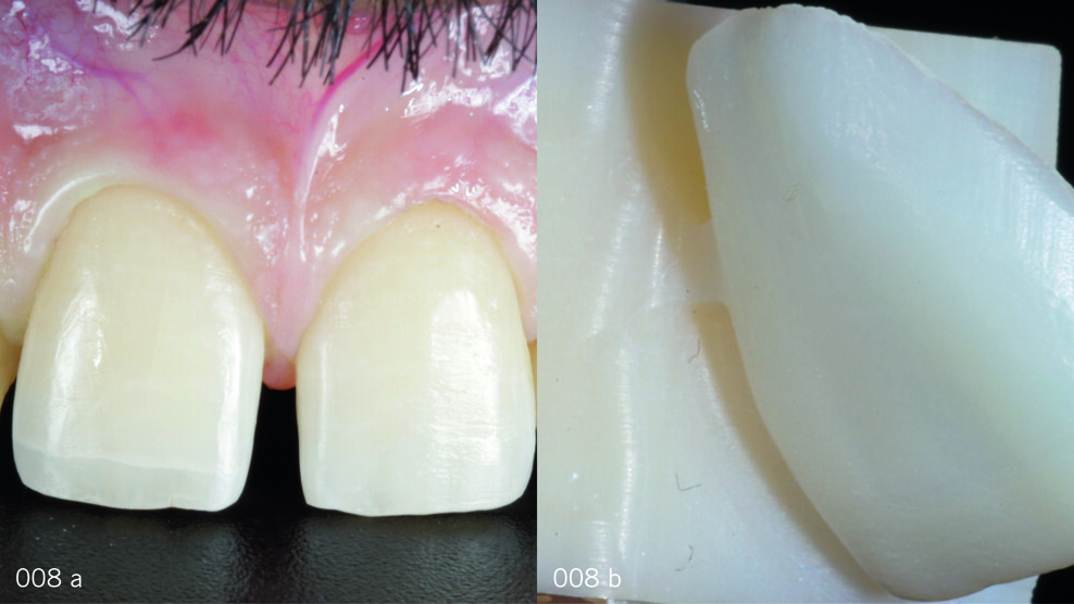 Fig. 8a: Completed extremely minimally invasive preparations without finishing lines ready for digital impression taking. Fig. 8b: First veneer fabricated by digital milling.