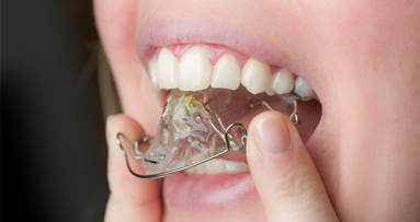 Nickel in Zahnspangen: Selten Allergieauslöser