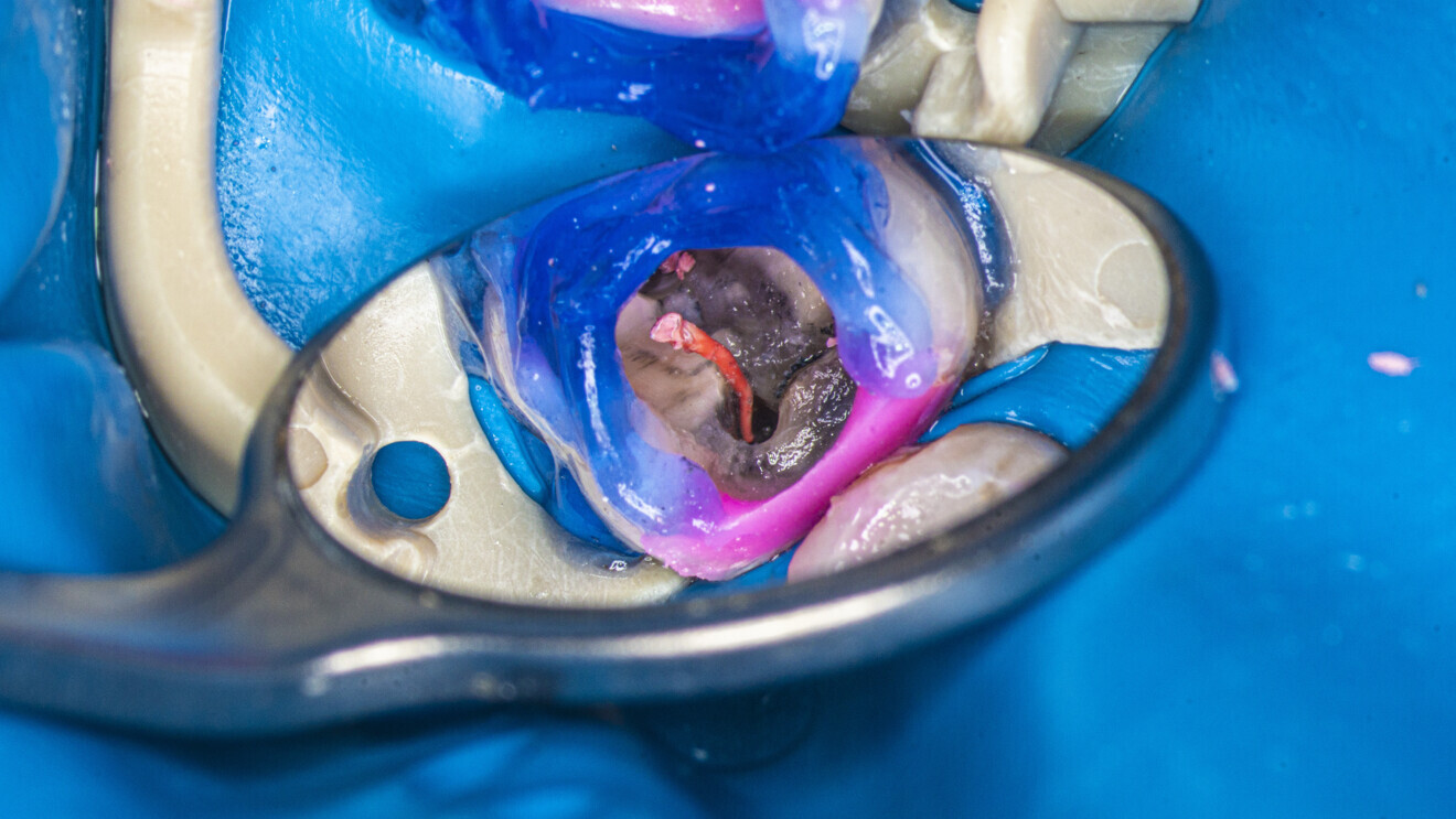 Fig. 30: Removal of the gutta-percha.