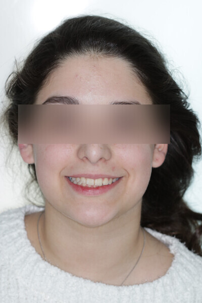 Fig. 3: Initial situation. Class II malocclusion patient.