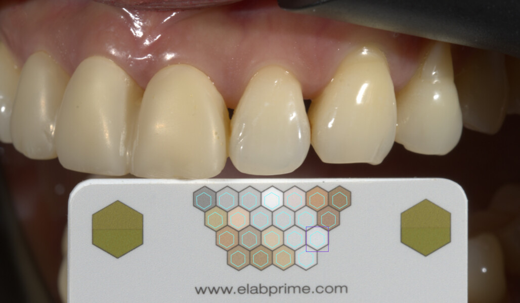 Fig. 3: Shade determination with the eLAB system (Emulation S.Hein).