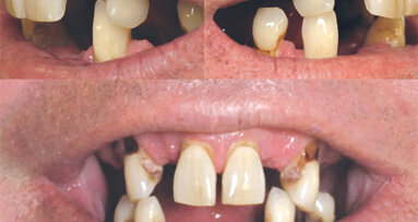 Una solución para cada arcada