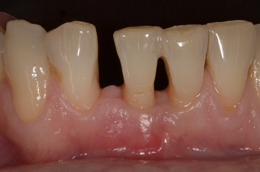 Figg. 6k-6m - Guarigione ad 1 mese.