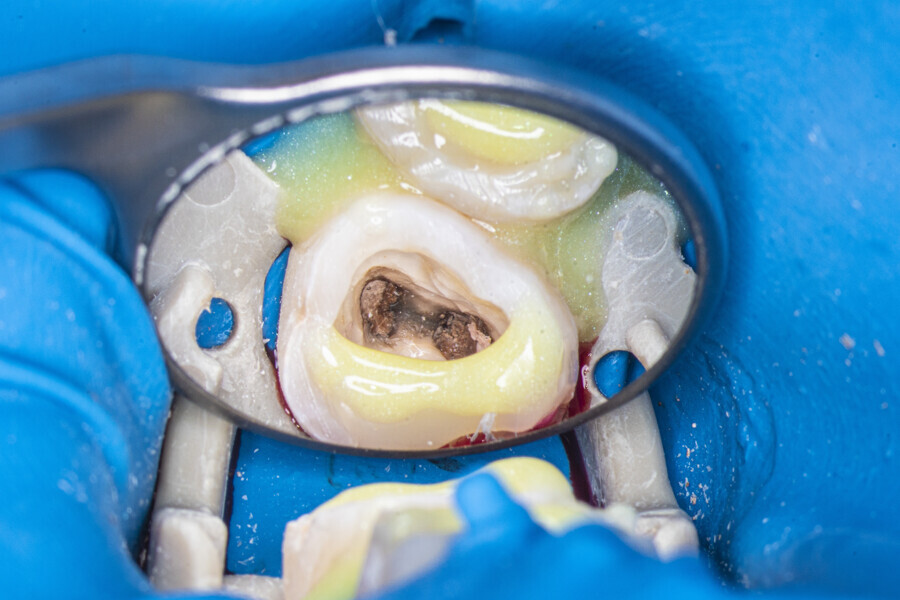 Fig. 14: Temporary build-up for increasing the amount of irrigant during the Less-Prep Endo enhanced irrigation protocol.