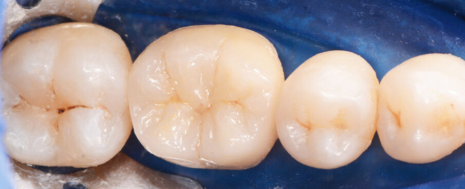 Fig. 11: Seated crown after excess removal