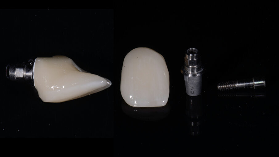 Fig. 34_Dente protesico definitivo dopo le opportune fasi di finalizzazione.