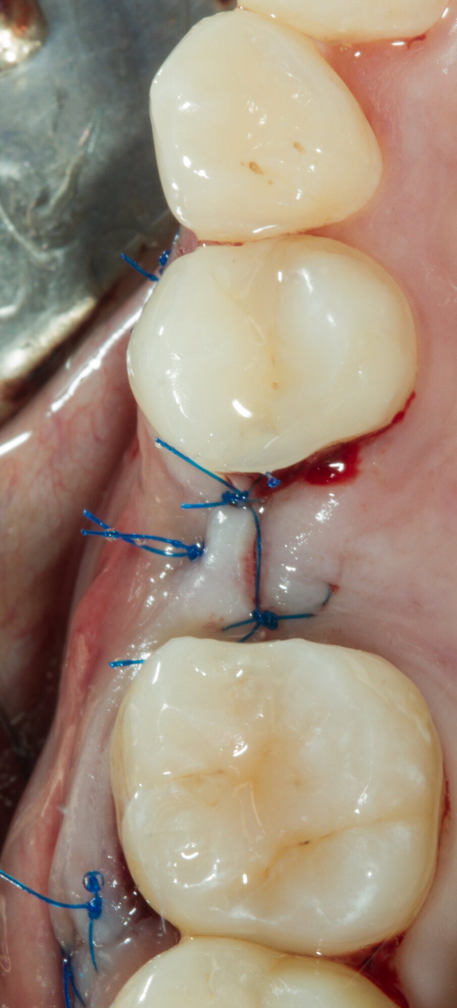 Fig. 14 - Sutura a materassaio orizzontale.