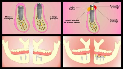 Carga inmediata o diferida en la mandíbula completamente edéntula