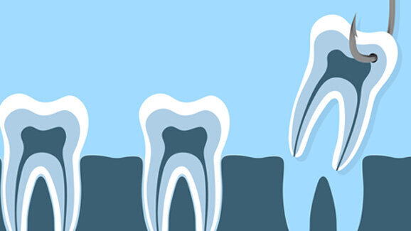 Extraktion dritter Molaren – Welche Probleme treten danach auf?