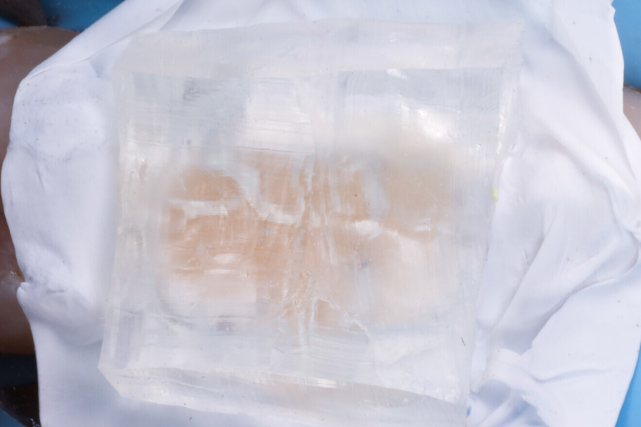 Fig. 17: Silicone index seated over the unpolymerised composite.