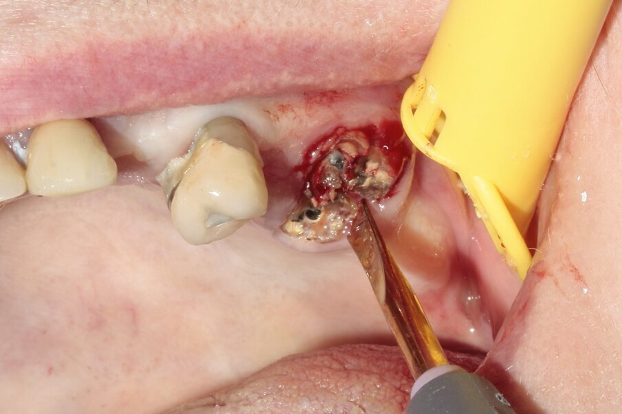 Fig. 4: Elevation of the palatal root.