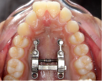 Fig 7b: Post expansion