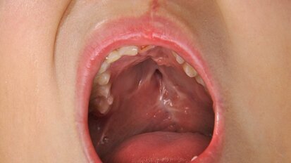 New study aims to understand genetic synergy in cleft palate