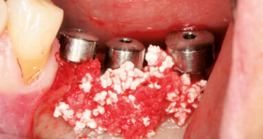 Řízená kostní regenerace  kolem implantátů s periimplantátovými kostními defekty