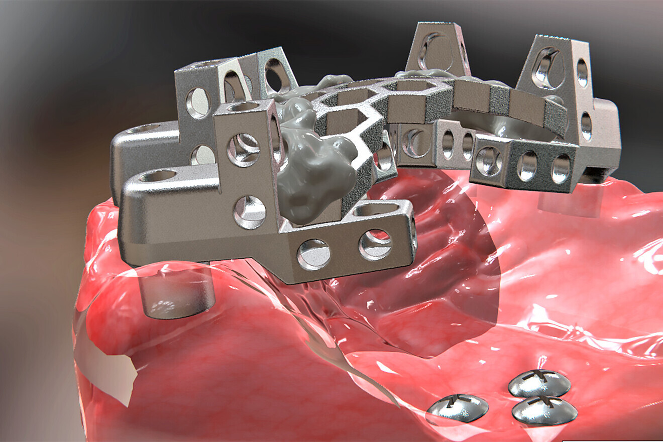 Fig. 3b: Completed Grammetry intra-oral structure secured to MUAs with conventional screws.