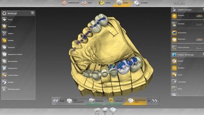 Sirona – Il software inLab, completamente rivisitato, offre una libertà straordinaria