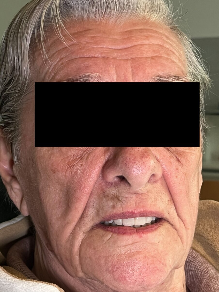 Fig. 11_La protesi inserita e ribasata all’arcata superiore.