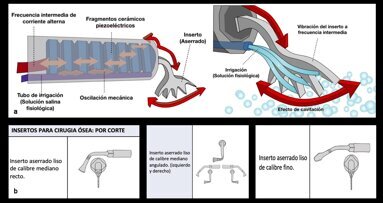 Piezocirugía  (4). Principios generales de la tecnología piezoeléctrica