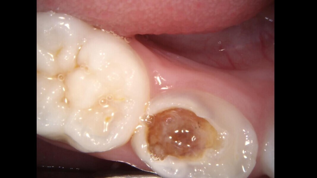 Fig. 14: Severe decay.