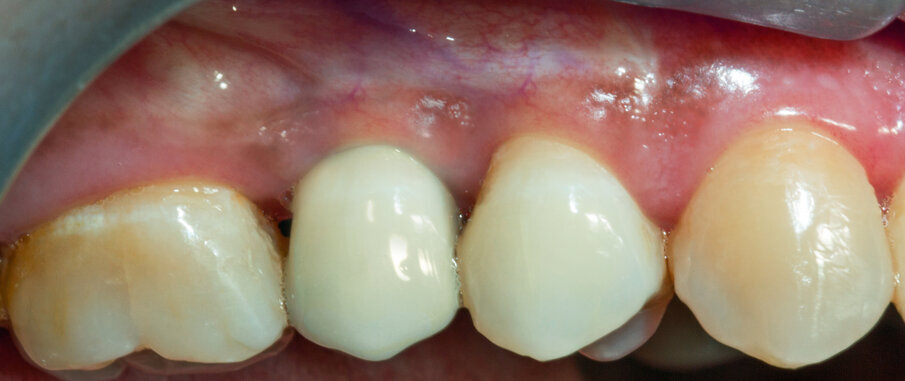 Fig. 27 - Corona protesica definitiva cementata.