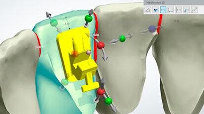 La digitalización del cementado indirecto
