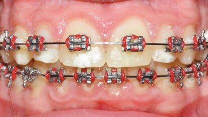 Protocollo sperimentale per la gestione dei tessuti duri durante il trattamento ortodontico