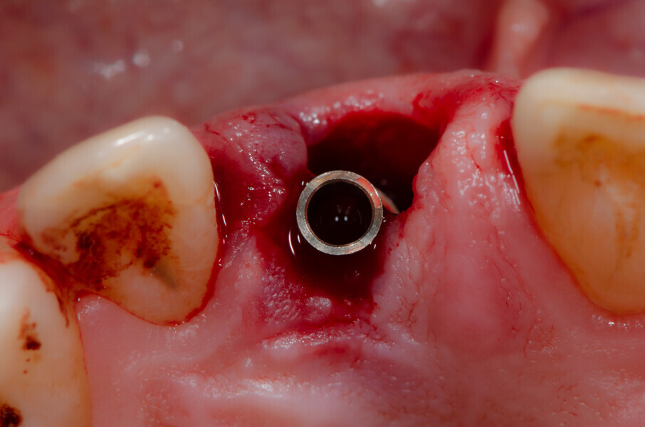 Fig. 16b: Implant with the titanium base inserted, occlusal view.