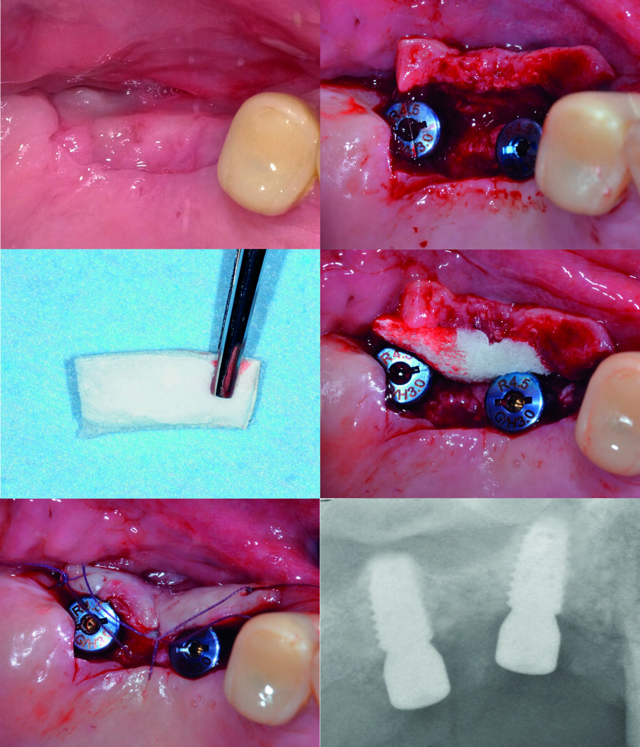 Fig. 4 - Gestione dei tessuti molli perimplantari. Al fine di ottenere una gengiva aderente di opportuna ampiezza e spessore, dopo avere posizionato le viti di guarigione, viene approntato un lembo a scivolamento apicale sotto il quale è innestata una matrice collagenica tridimensionale.