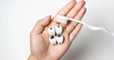 New antibacterial fillings may combat recurring dental caries