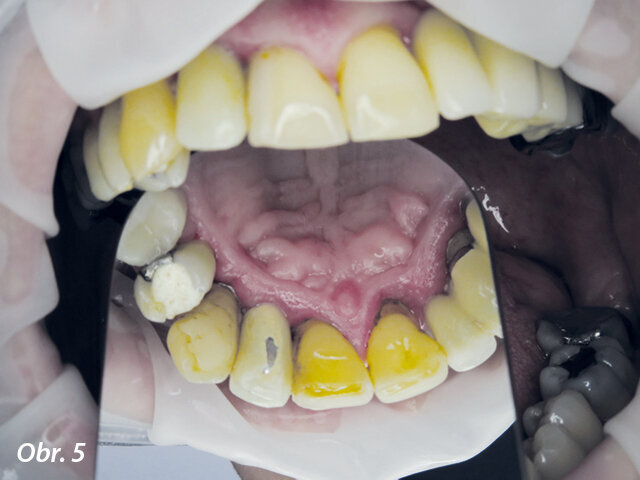 Obr. 3–5: Intraorální nález při vstupním vyšetření