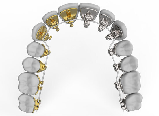 3D lingvální aparát eBrace