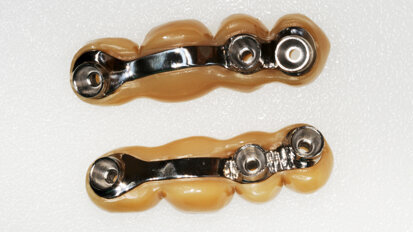 Okamžité zatížení implantátů v distálním úseku horní čelisti dvěma šroubovanými můstky vyrobenými digitálním pracovním postupem