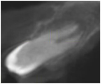 Ryc. 12_TK 18 miesięcy po zabiegu.