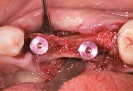 Fig. 12 - Riempimento del gap mediante osso eterologo.