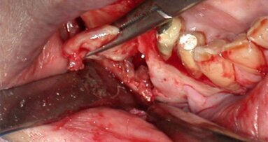 Spontaneous bone regeneration after removal of cysts: One-year follow-up of 336 consecutive cases