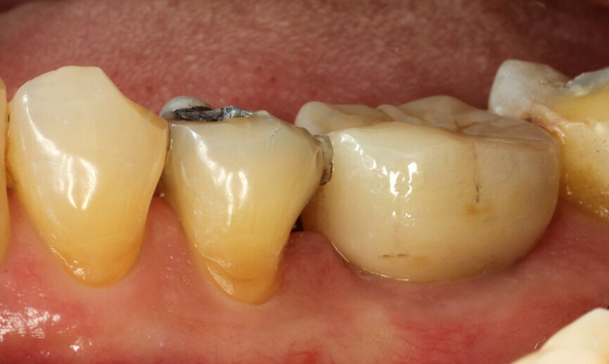 Fig. 24: Final result—lateral view.