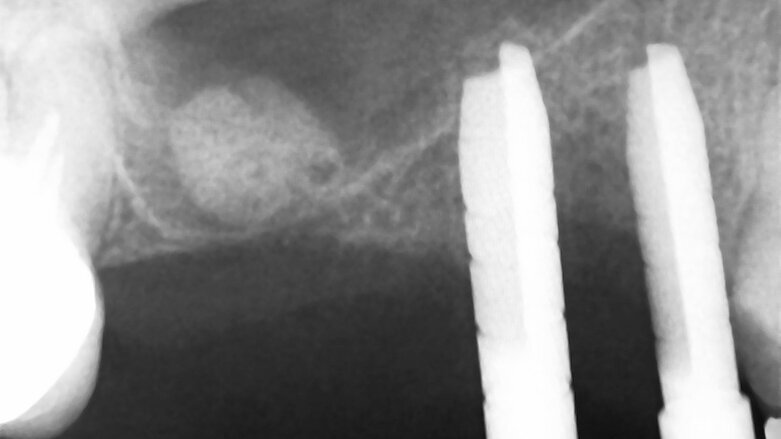 Minimálně invazivní krátké a úzké implantáty