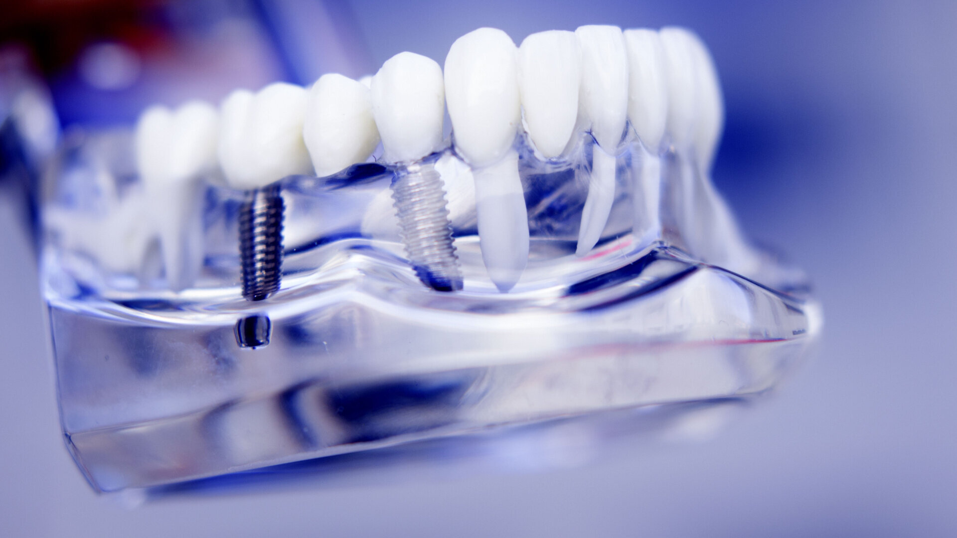 The transparent gingiva project IV