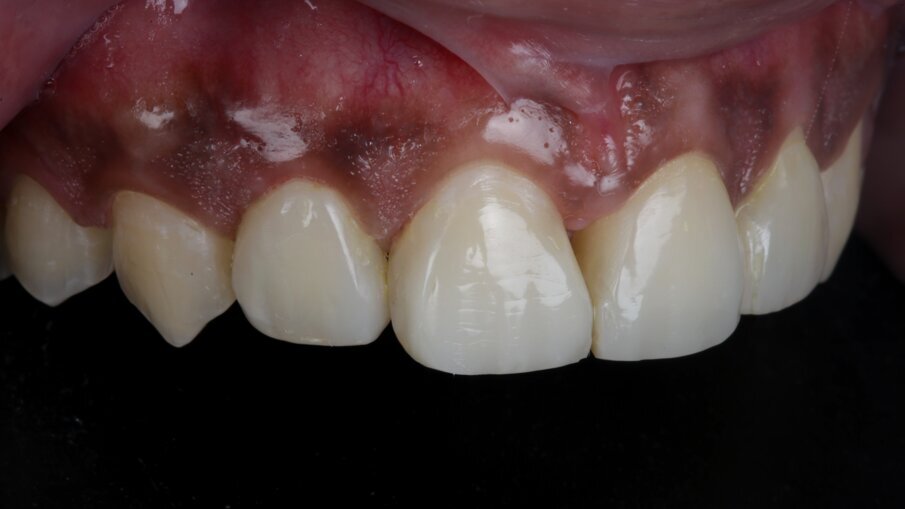 Fig 20: Final Post-op