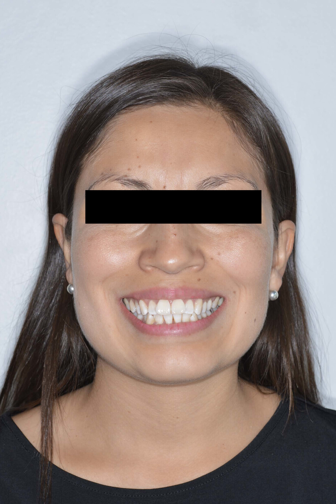 Fig. 1b: Initial extra-oral photographs.