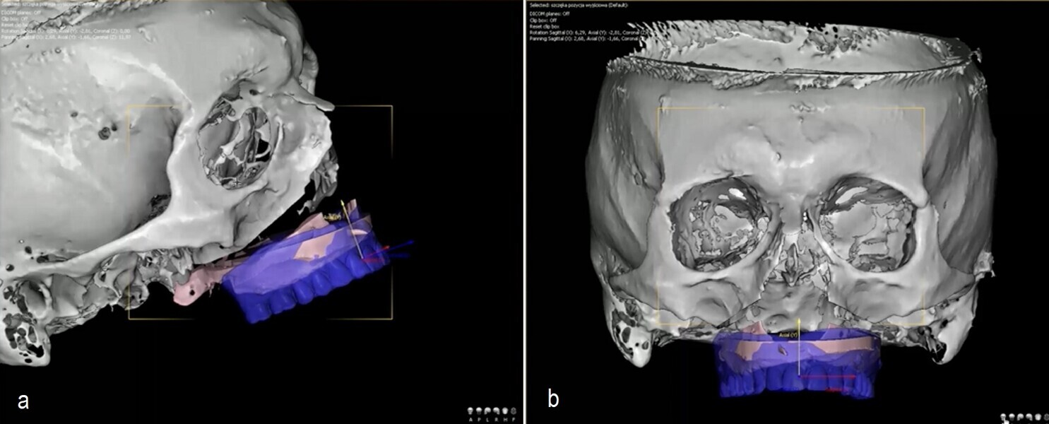 Figs. 2a & b: Digital design of the Le Fort I osteotomy involving precise alignment of the maxillary intra-oral scan with the CBCT scan for creation of a digital model that accurately reflected the patient’s anatomy, ensuring correct implant and maxillary positioning.
