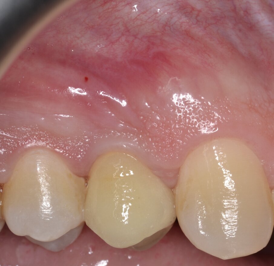Fig. 23 - Corona protesica definitiva in zirconia stratificata (visione buccale).