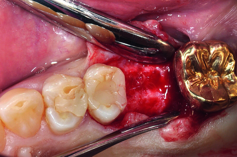 Fig. 3: The exposure of the alveolar ridge using full-flap formation.